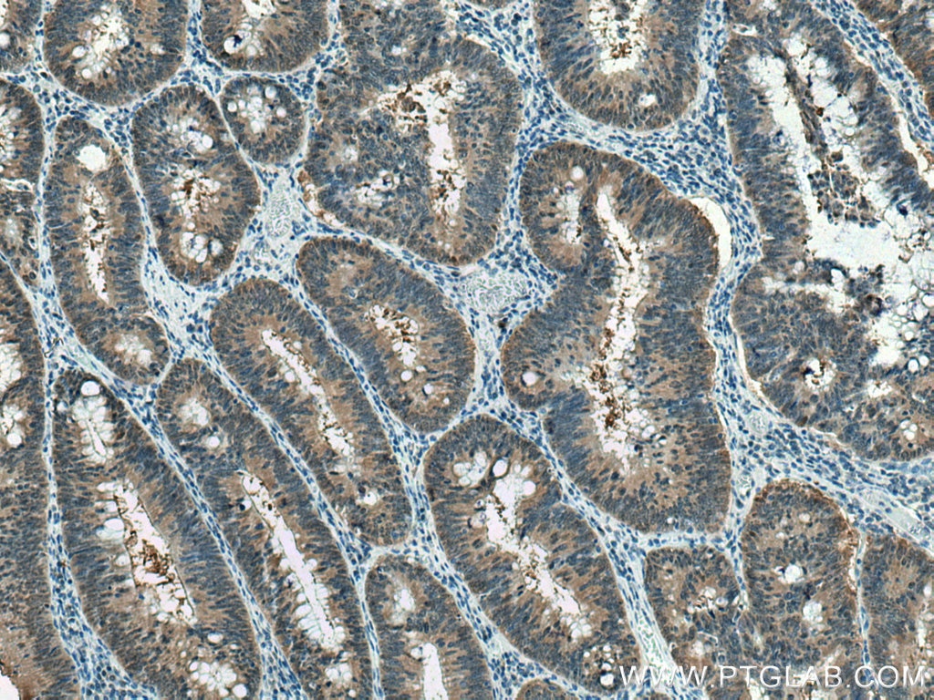 IHC staining of human colon cancer using 11684-2-AP