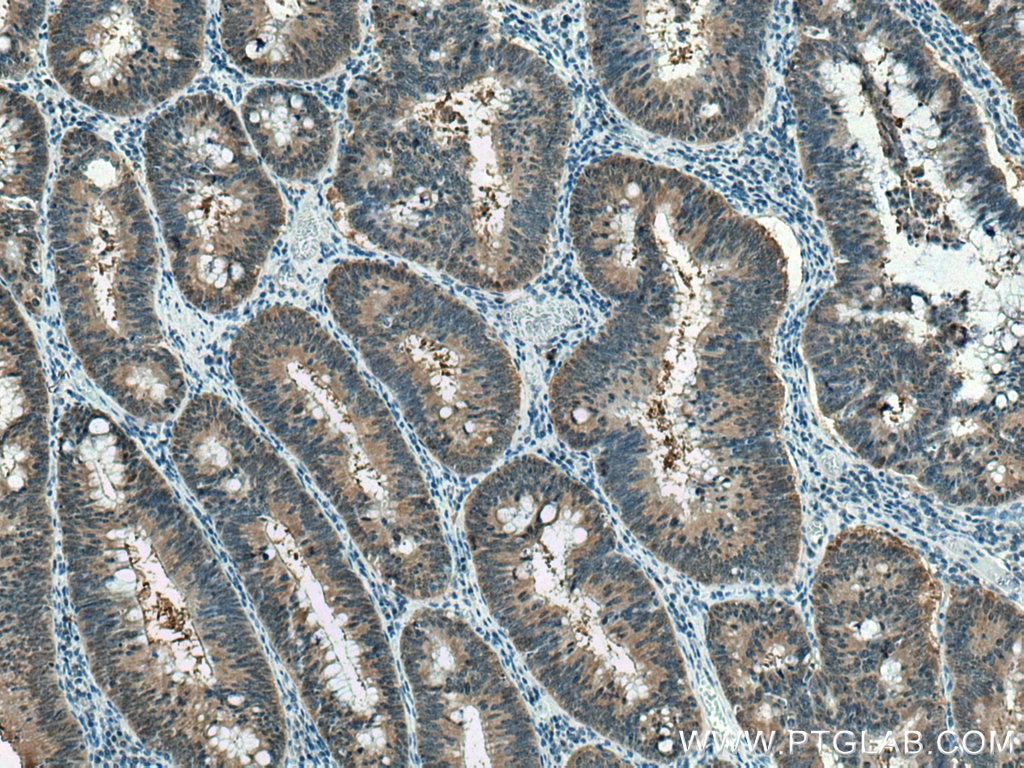 Immunohistochemistry (IHC) staining of human colon cancer tissue using PSMB6 Polyclonal antibody (11684-2-AP)