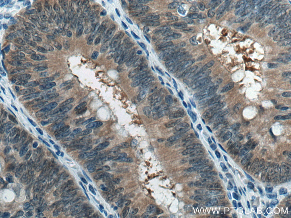 Immunohistochemistry (IHC) staining of human colon cancer tissue using PSMB6 Polyclonal antibody (11684-2-AP)