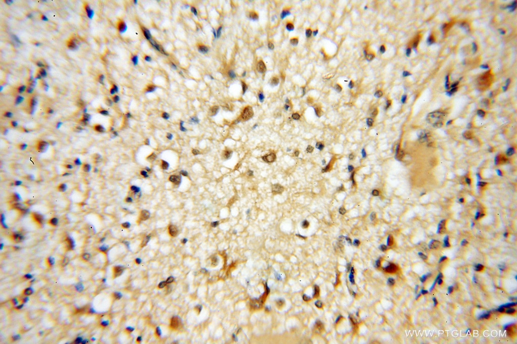 Immunohistochemistry (IHC) staining of human gliomas tissue using PSMB6 Polyclonal antibody (11684-2-AP)