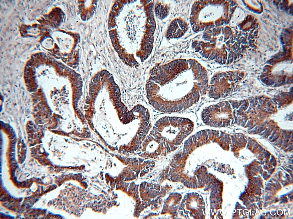 Immunohistochemistry (IHC) staining of human colon cancer tissue using PSMB7 Polyclonal antibody (14727-1-AP)