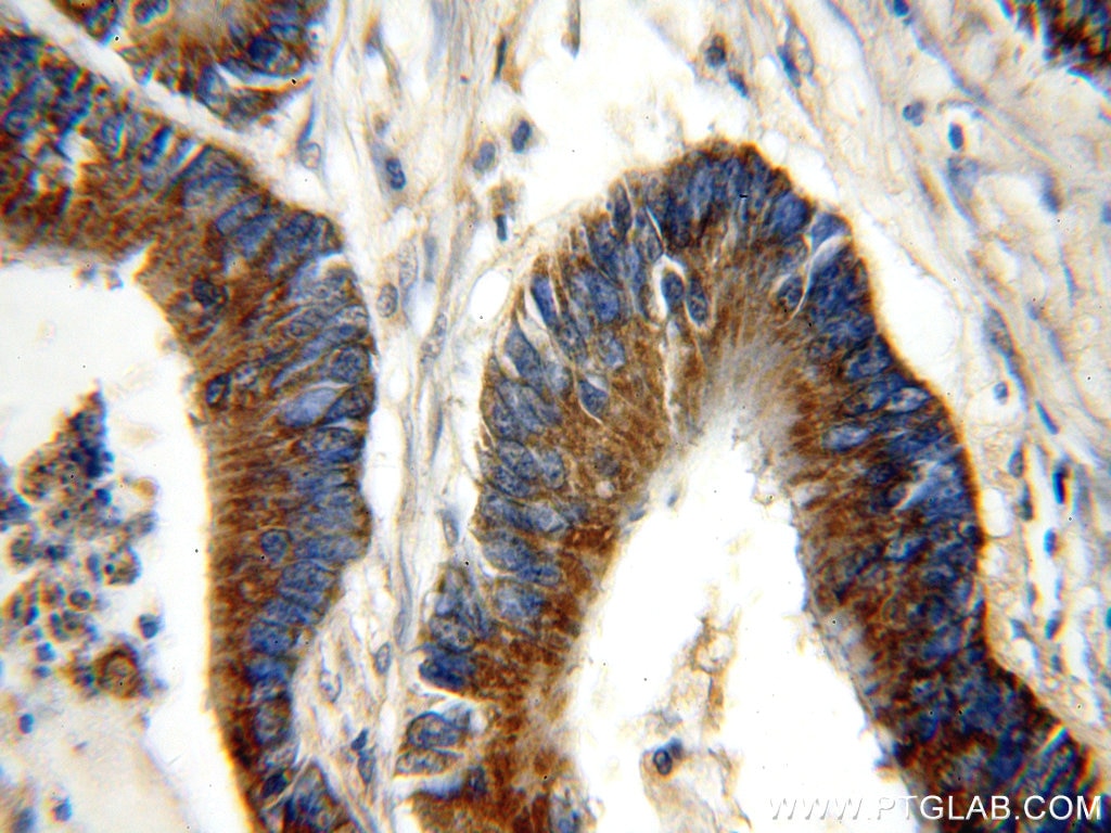 Immunohistochemistry (IHC) staining of human colon cancer tissue using PSMB7 Polyclonal antibody (14727-1-AP)