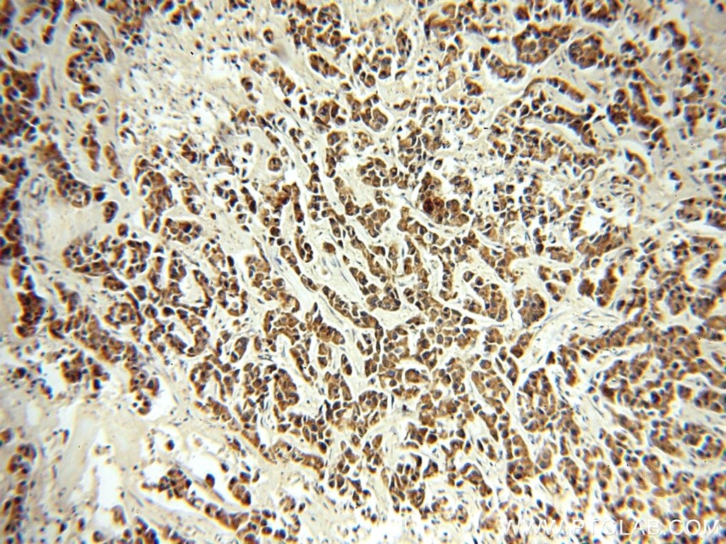 Immunohistochemistry (IHC) staining of human breast cancer tissue using PSMB7 Polyclonal antibody (14727-1-AP)