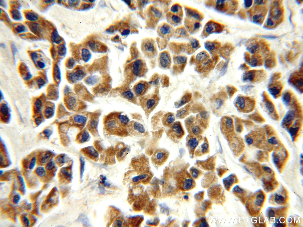 Immunohistochemistry (IHC) staining of human breast cancer tissue using PSMB7 Polyclonal antibody (14727-1-AP)