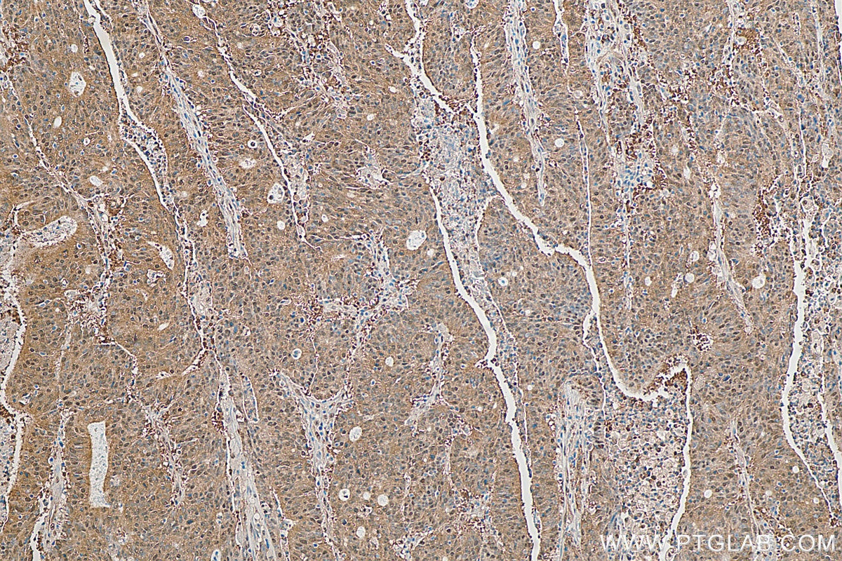 Immunohistochemistry (IHC) staining of human colon cancer tissue using PSMB7 Polyclonal antibody (30283-1-AP)
