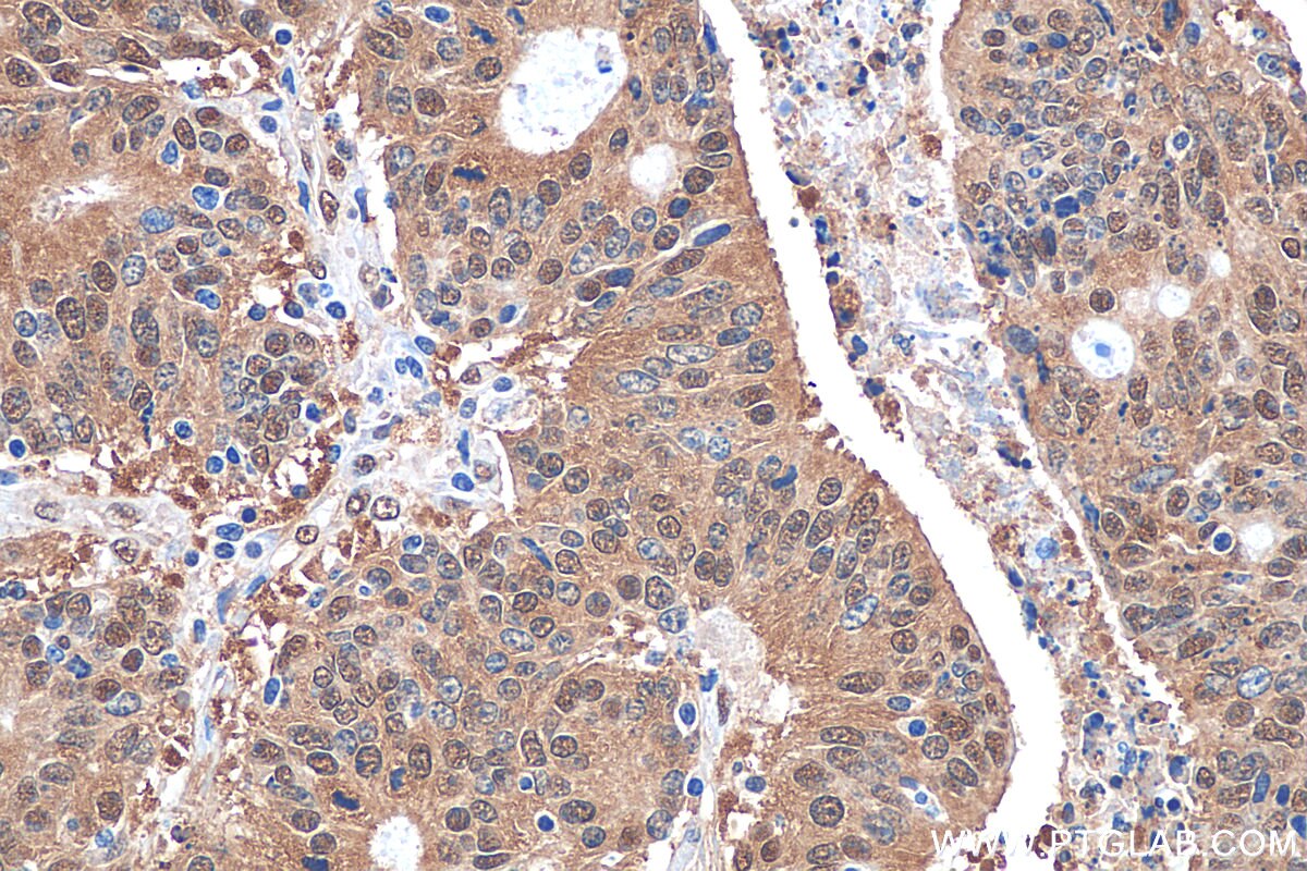 Immunohistochemistry (IHC) staining of human colon cancer tissue using PSMB7 Polyclonal antibody (30283-1-AP)
