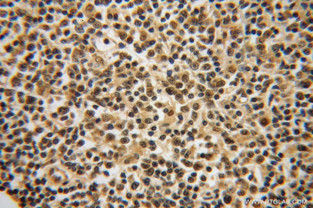 IHC staining of human lymphoma using 14859-1-AP