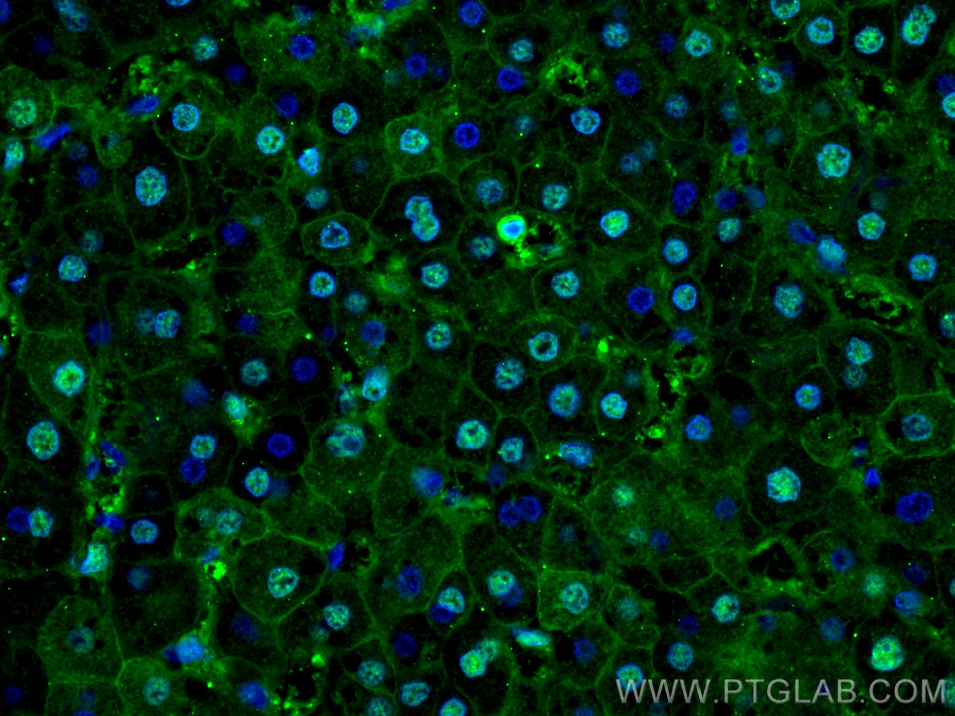 Immunofluorescence (IF) / fluorescent staining of human liver cancer tissue using PSMB8 Monoclonal antibody (66759-1-Ig)