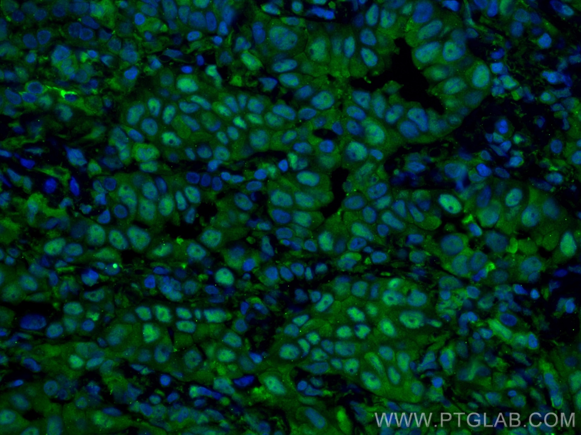Immunofluorescence (IF) / fluorescent staining of human lung cancer tissue using PSMB8 Monoclonal antibody (66759-1-Ig)