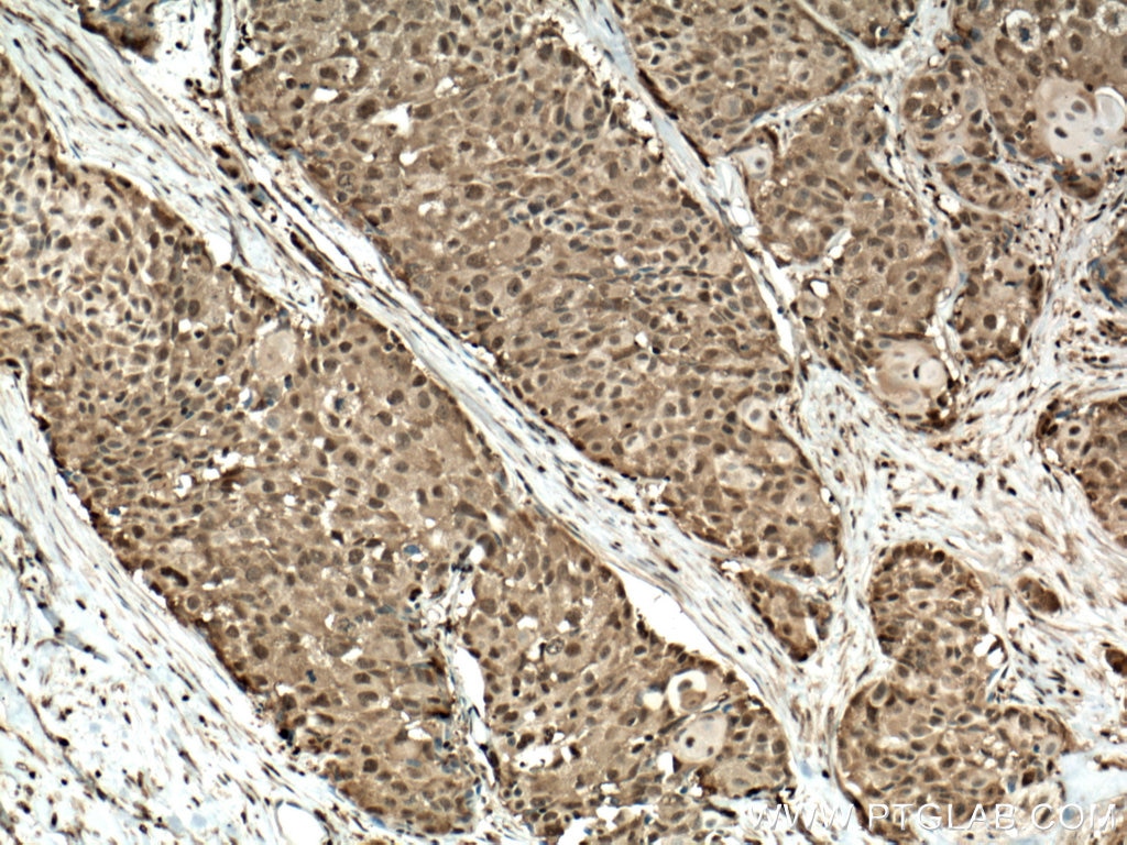 Immunohistochemistry (IHC) staining of human lung cancer tissue using PSMB8 Monoclonal antibody (66759-1-Ig)