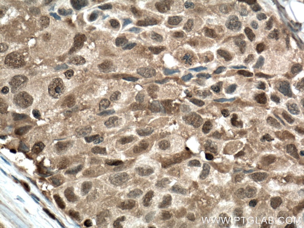 Immunohistochemistry (IHC) staining of human lung cancer tissue using PSMB8 Monoclonal antibody (66759-1-Ig)