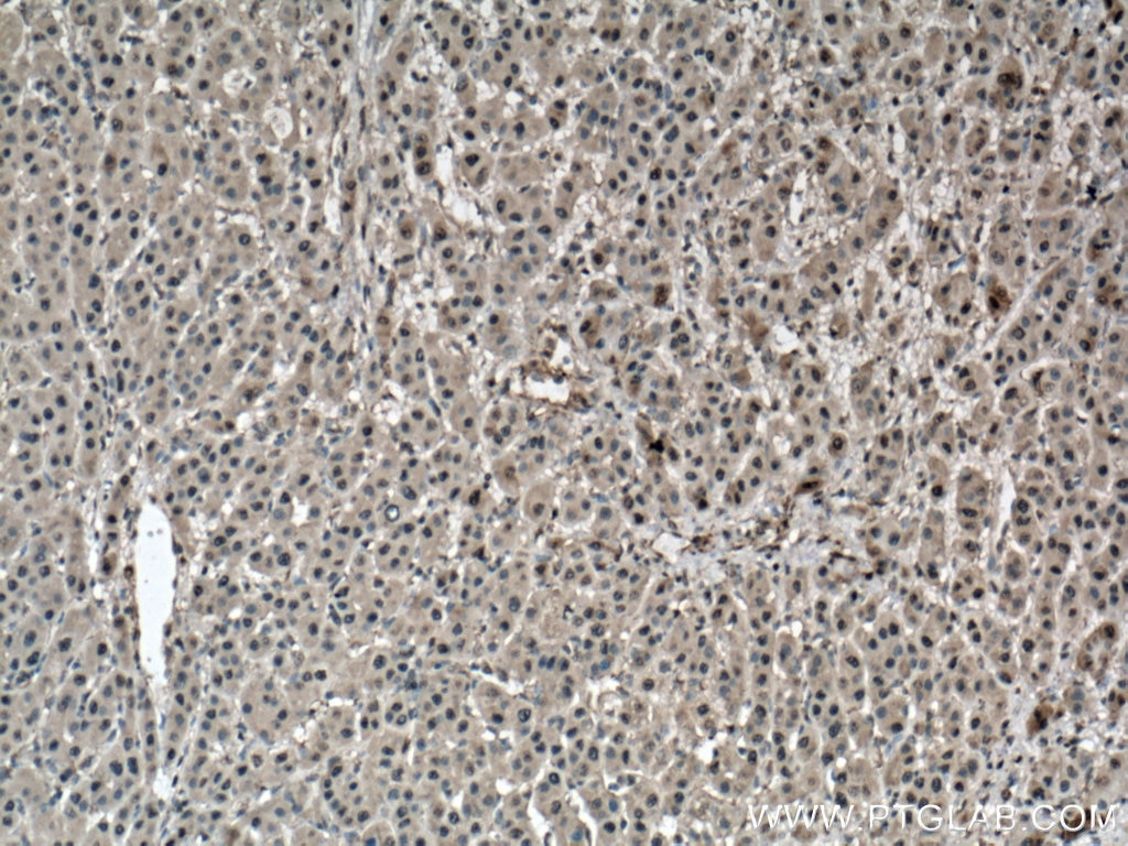 Immunohistochemistry (IHC) staining of human liver cancer tissue using PSMB8 Monoclonal antibody (66759-1-Ig)