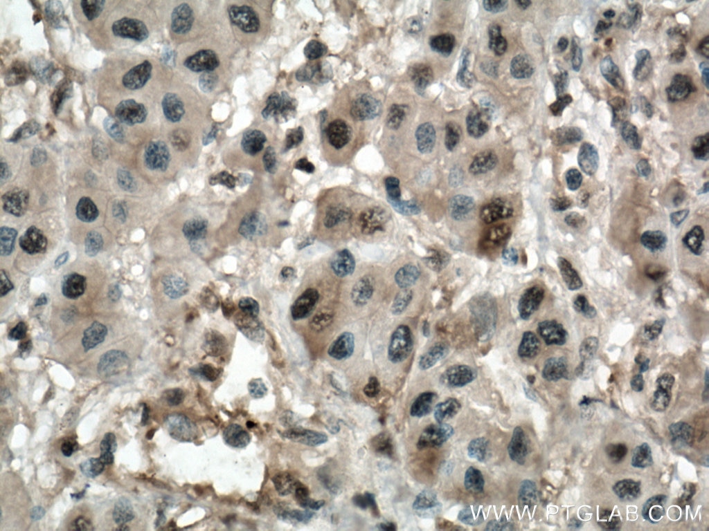 Immunohistochemistry (IHC) staining of human liver cancer tissue using PSMB8 Monoclonal antibody (66759-1-Ig)