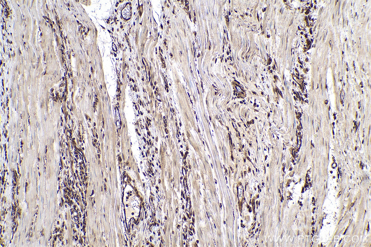 Immunohistochemistry (IHC) staining of human oesophagus cancer tissue using PSMB8 Monoclonal antibody (66759-1-Ig)