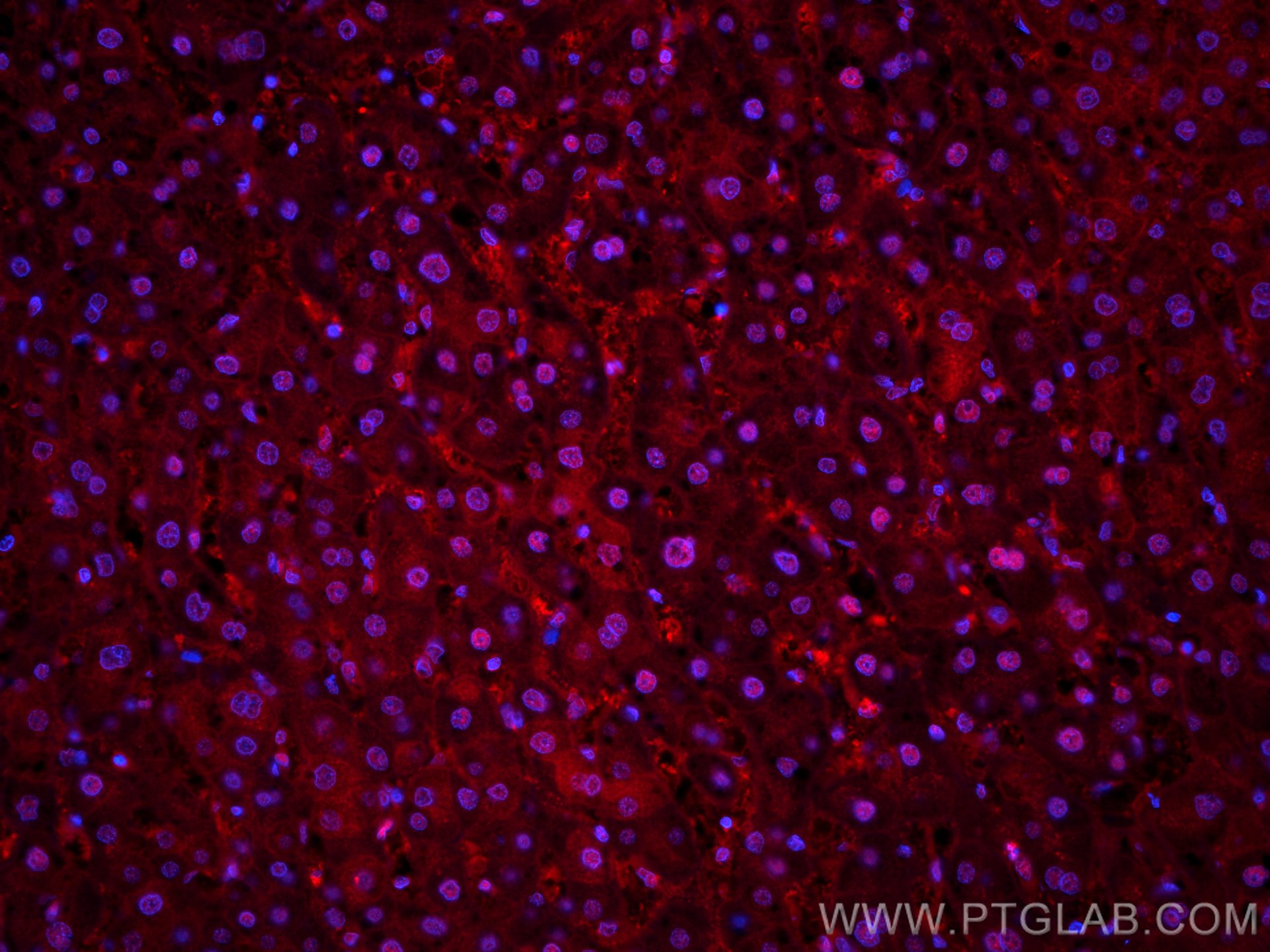 Immunofluorescence (IF) / fluorescent staining of human liver cancer tissue using CoraLite®594-conjugated PSMB8 Monoclonal antibody (CL594-66759)