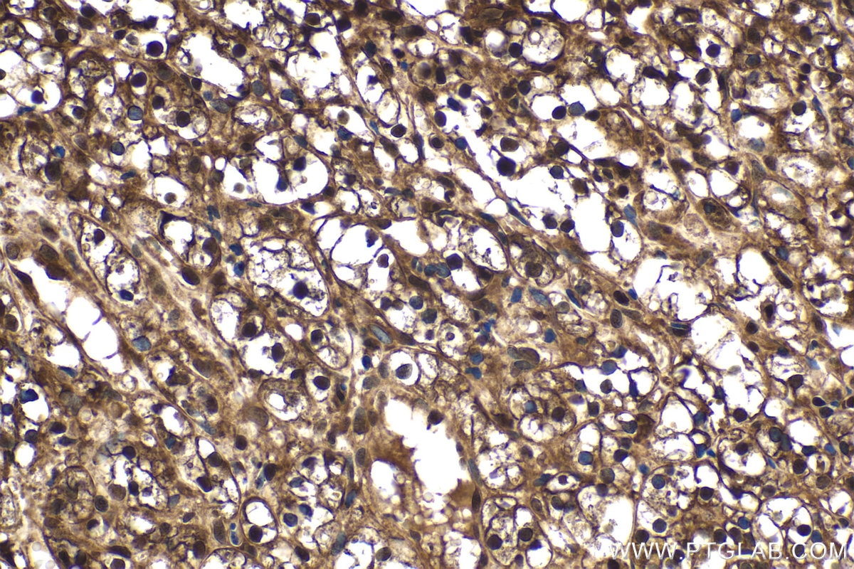 Immunohistochemistry (IHC) staining of human renal cell carcinoma tissue using PSMB9 Polyclonal antibody (14544-1-AP)