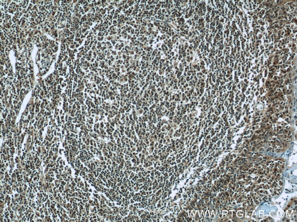 Immunohistochemistry (IHC) staining of human tonsillitis tissue using PSMB9 Polyclonal antibody (14544-1-AP)