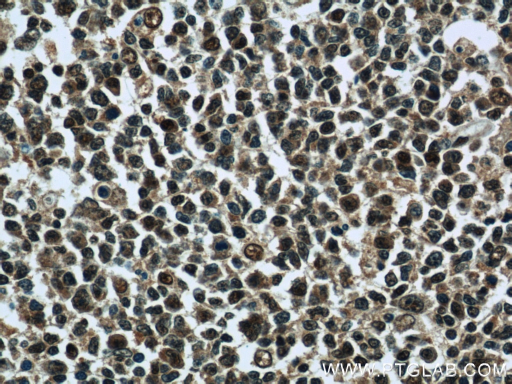 Immunohistochemistry (IHC) staining of human tonsillitis tissue using PSMB9 Polyclonal antibody (14544-1-AP)