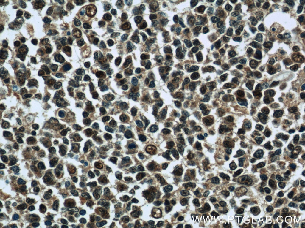 IHC staining of human tonsillitis using 14544-1-AP