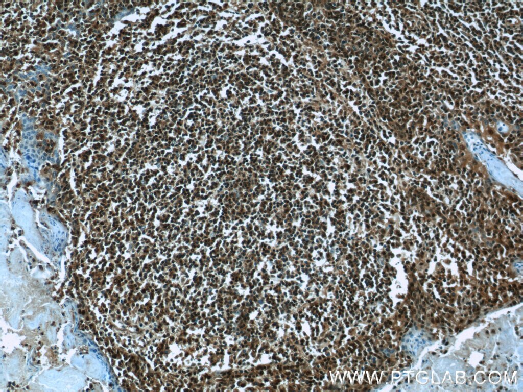 Immunohistochemistry (IHC) staining of human tonsillitis tissue using PSMB9 Polyclonal antibody (14544-1-AP)