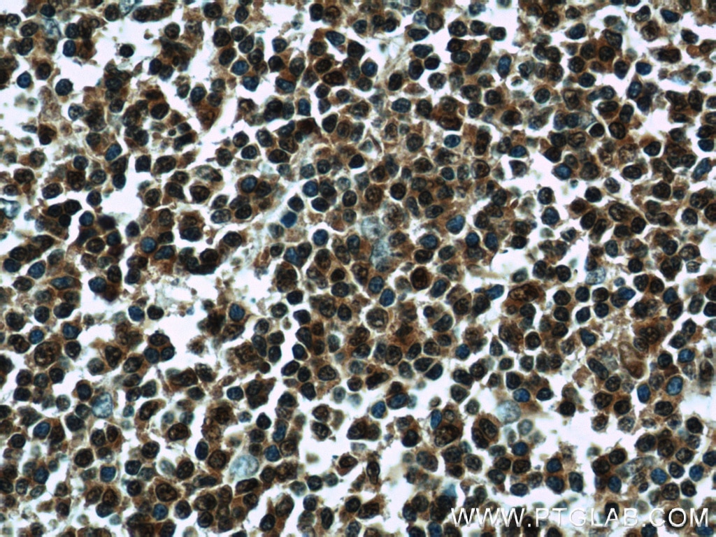 Immunohistochemistry (IHC) staining of human tonsillitis tissue using PSMB9 Polyclonal antibody (14544-1-AP)