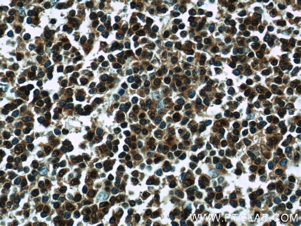 IHC staining of human tonsillitis using 14544-1-AP