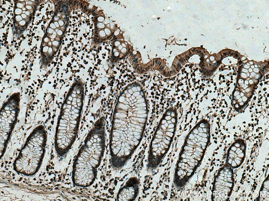 IHC staining of human colon cancer using 67748-1-Ig