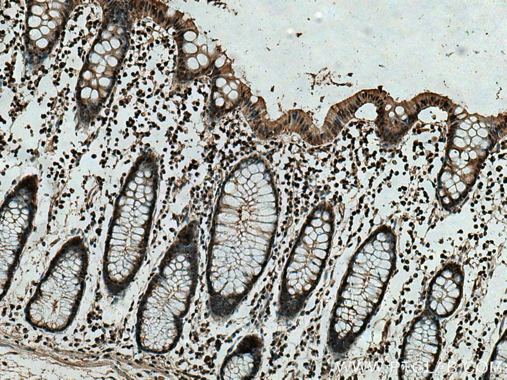 Immunohistochemistry (IHC) staining of human colon cancer tissue using PSMB9 Monoclonal antibody (67748-1-Ig)