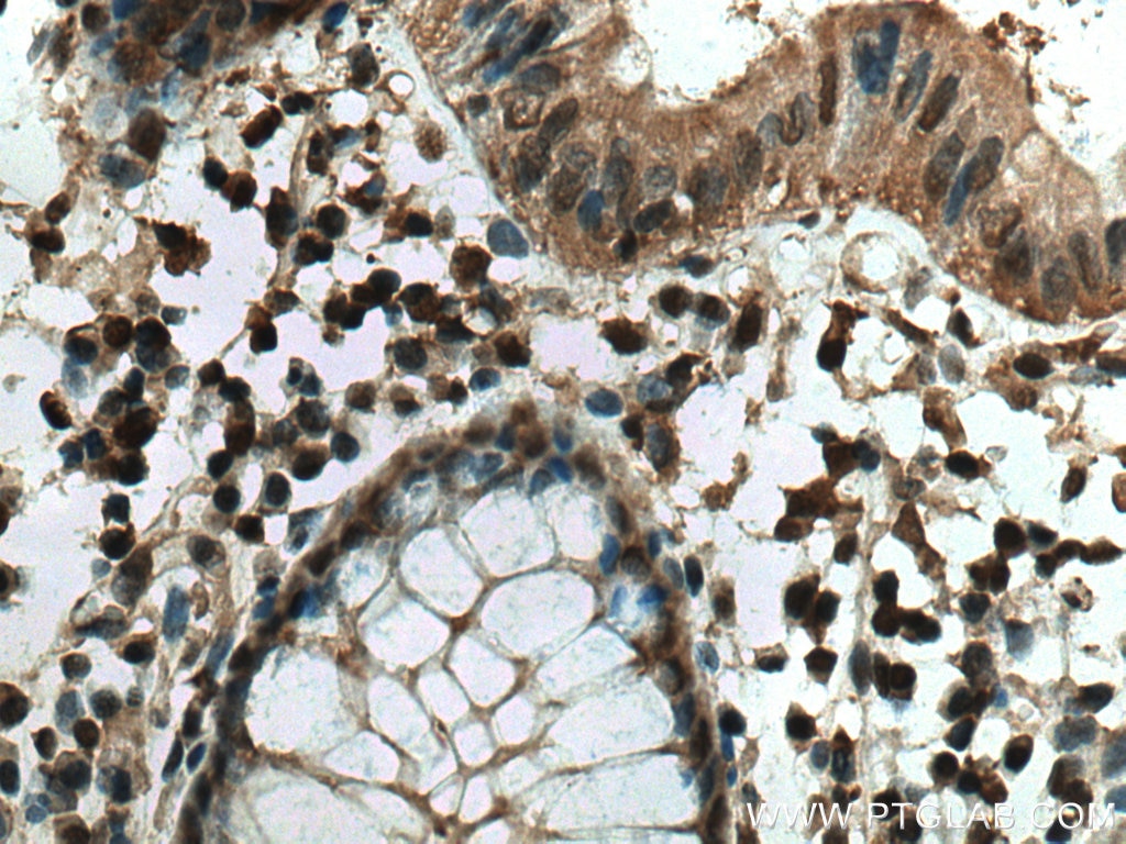 Immunohistochemistry (IHC) staining of human colon cancer tissue using PSMB9 Monoclonal antibody (67748-1-Ig)