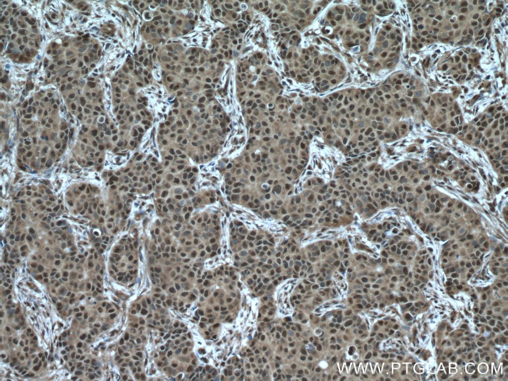 Immunohistochemistry (IHC) staining of human breast cancer tissue using PSMC2 Polyclonal antibody (14905-1-AP)