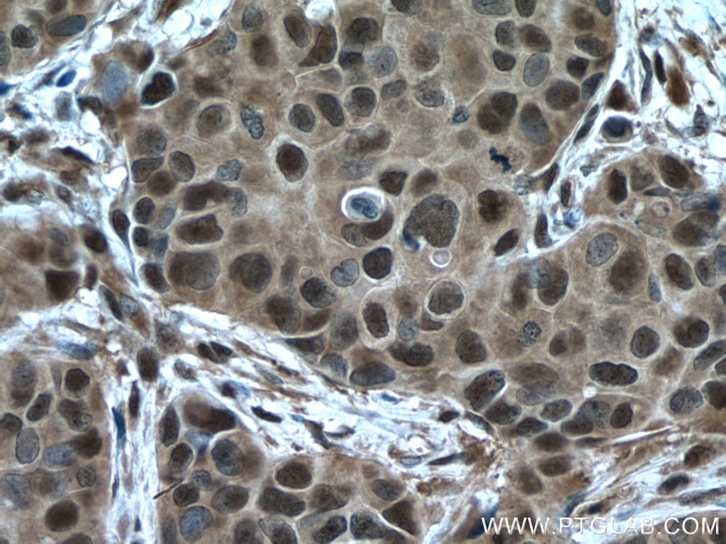 Immunohistochemistry (IHC) staining of human breast cancer tissue using PSMC2 Polyclonal antibody (14905-1-AP)