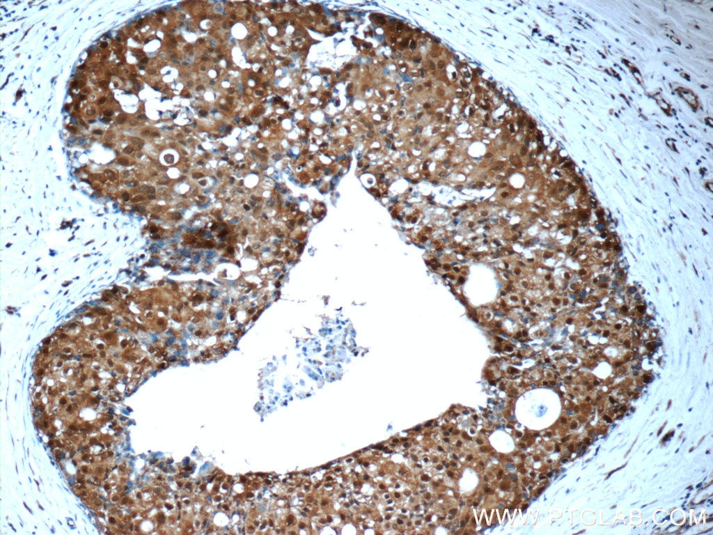 Immunohistochemistry (IHC) staining of human breast cancer tissue using PSMC2 Polyclonal antibody (14905-1-AP)