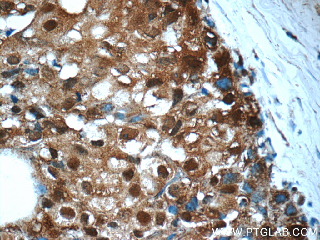 Immunohistochemistry (IHC) staining of human breast cancer tissue using PSMC2 Polyclonal antibody (14905-1-AP)