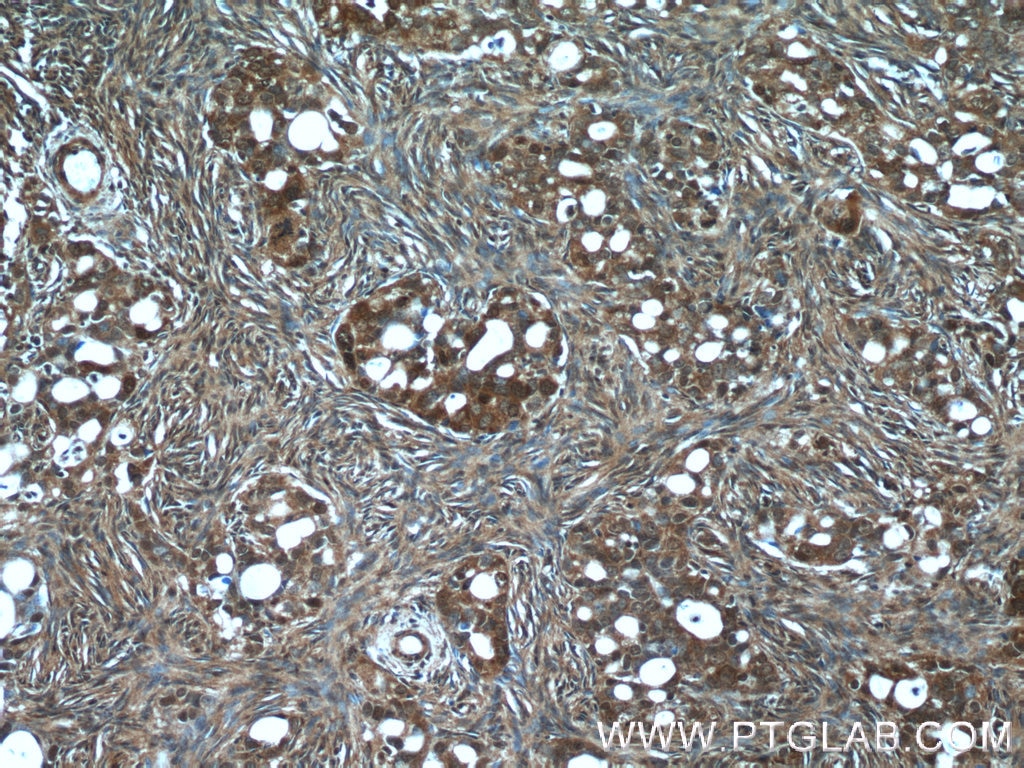 Immunohistochemistry (IHC) staining of human ovary tumor tissue using PSMC3 Polyclonal antibody (24142-1-AP)