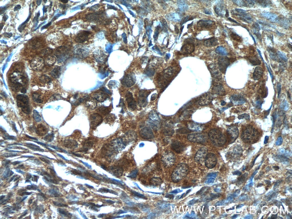 Immunohistochemistry (IHC) staining of human ovary tumor tissue using PSMC3 Polyclonal antibody (24142-1-AP)