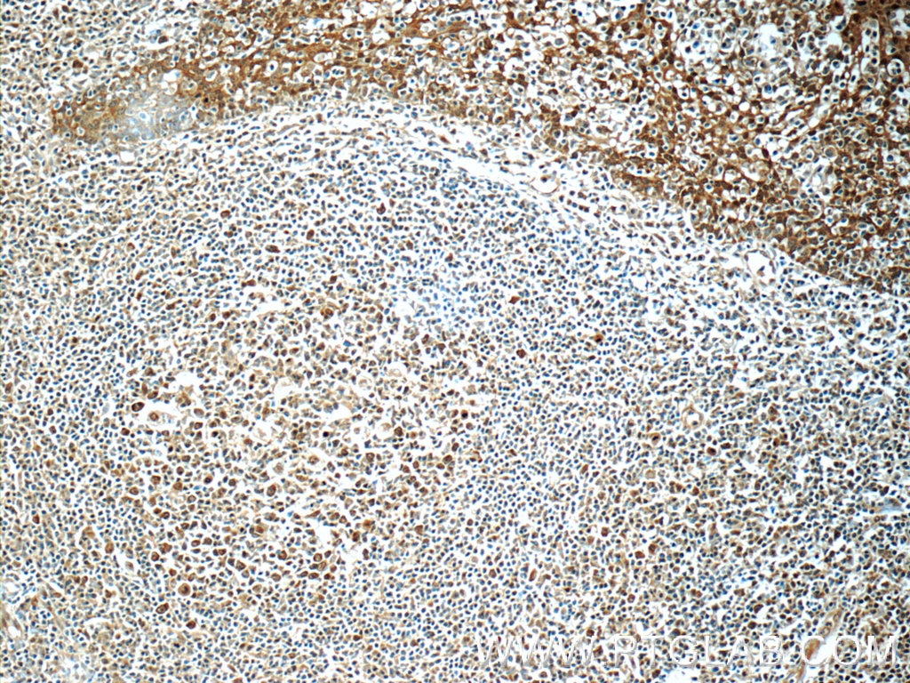 Immunohistochemistry (IHC) staining of human tonsillitis tissue using PSMC3 Polyclonal antibody (24142-1-AP)