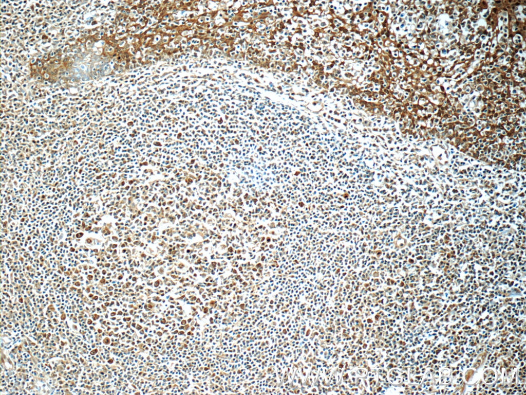 IHC staining of human tonsillitis using 24142-1-AP