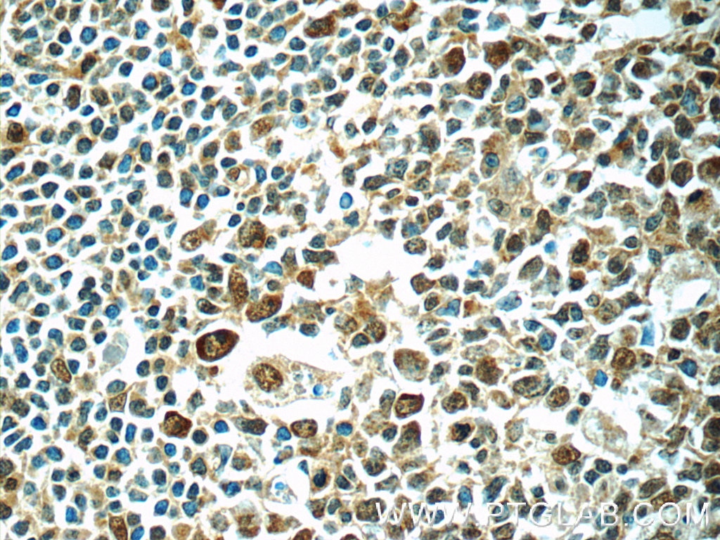Immunohistochemistry (IHC) staining of human tonsillitis tissue using PSMC3 Polyclonal antibody (24142-1-AP)