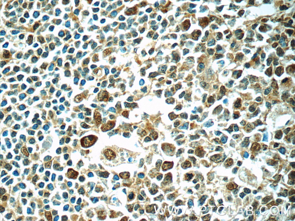 IHC staining of human tonsillitis using 24142-1-AP