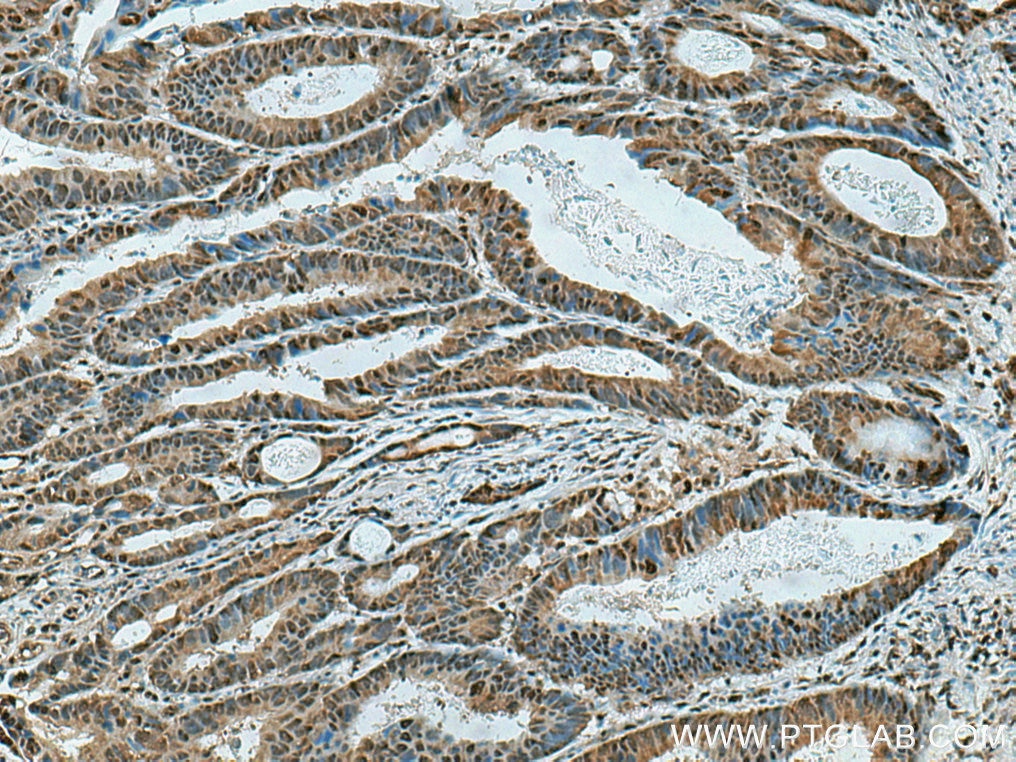 Immunohistochemistry (IHC) staining of human colon cancer tissue using PSMC4 Polyclonal antibody (11389-1-AP)