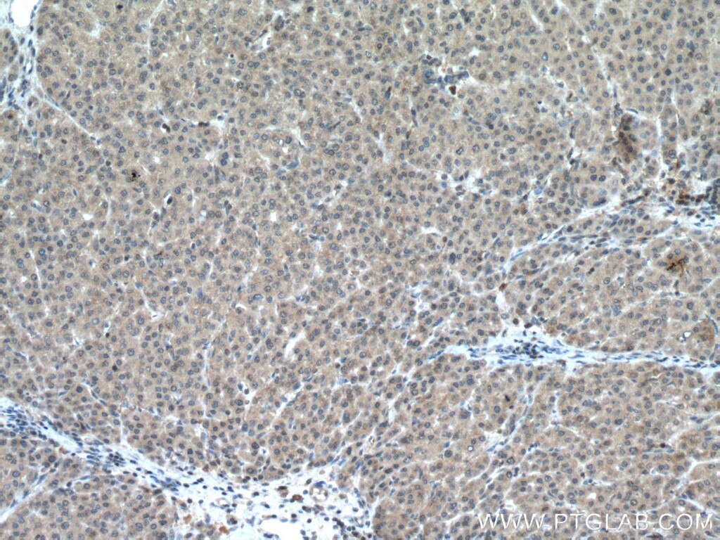 Immunohistochemistry (IHC) staining of human liver cancer tissue using PSMC5 Polyclonal antibody (14752-1-AP)