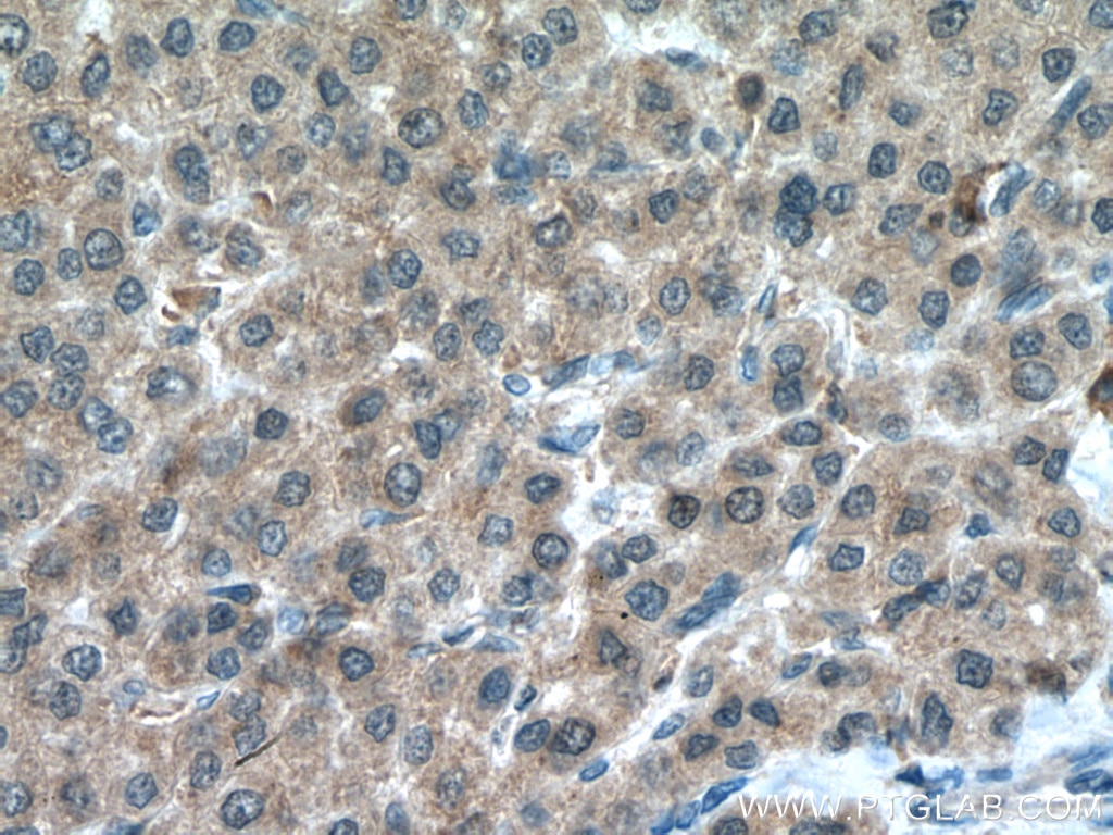 Immunohistochemistry (IHC) staining of human liver cancer tissue using PSMC5 Polyclonal antibody (14752-1-AP)
