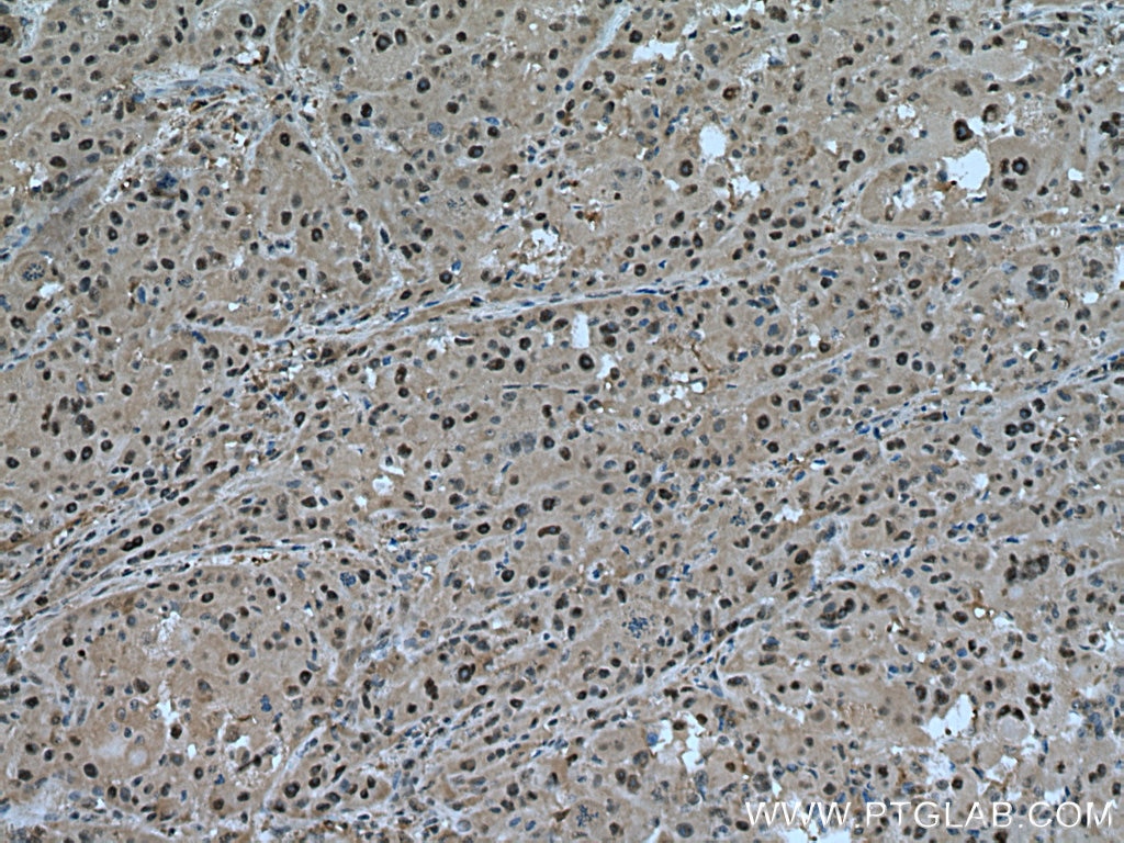 Immunohistochemistry (IHC) staining of human liver cancer tissue using PSMC6 Polyclonal antibody (15839-1-AP)