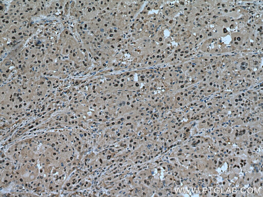 Immunohistochemistry (IHC) staining of human liver cancer tissue using PSMC6 Polyclonal antibody (15839-1-AP)