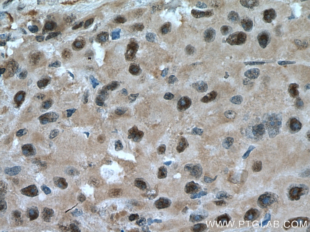 Immunohistochemistry (IHC) staining of human liver cancer tissue using PSMC6 Polyclonal antibody (15839-1-AP)