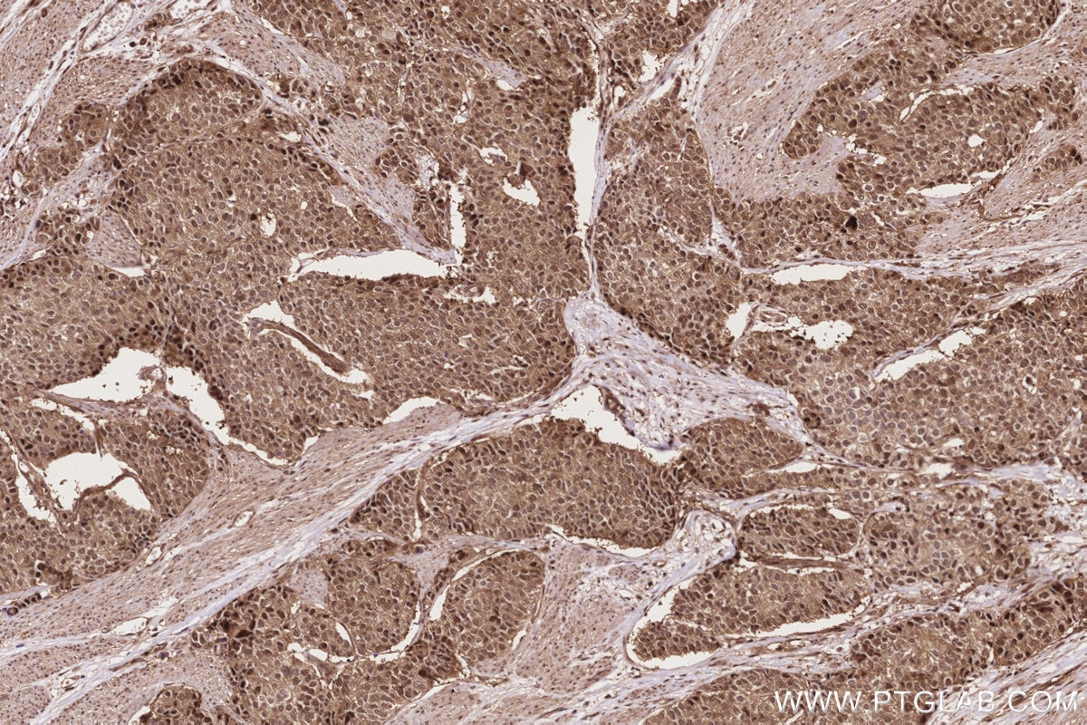Immunohistochemistry (IHC) staining of human stomach cancer tissue using PSMD1 Recombinant monoclonal antibody (83521-2-RR)