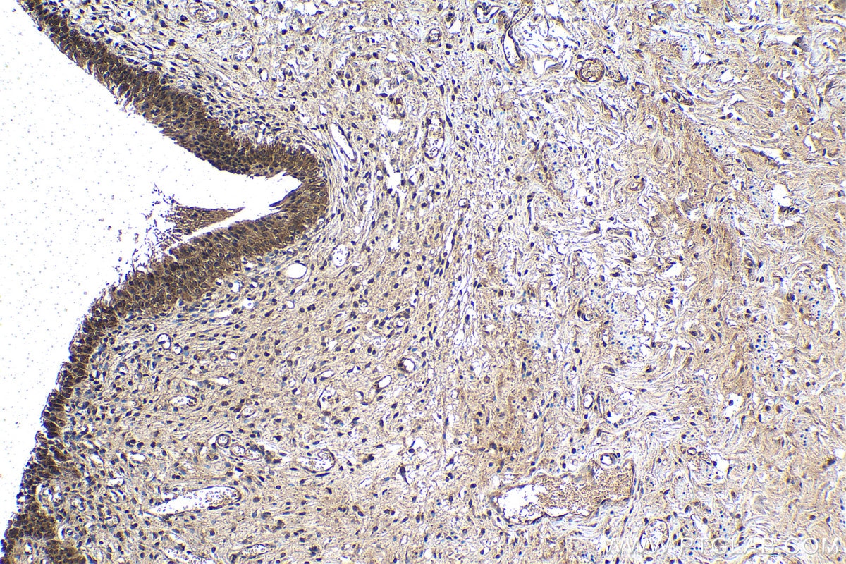Immunohistochemistry (IHC) staining of human urothelial carcinoma tissue using PSMD10 Polyclonal antibody (12342-2-AP)