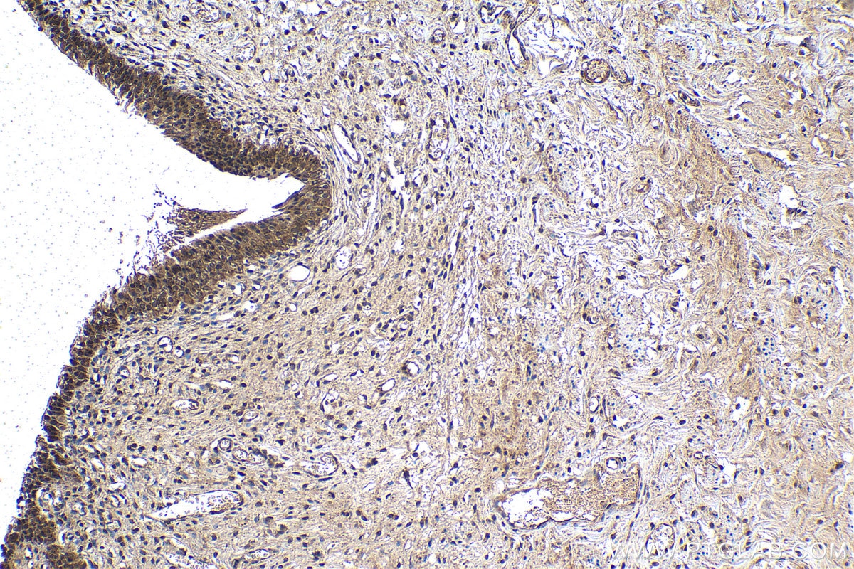 Immunohistochemistry (IHC) staining of human urothelial carcinoma tissue using PSMD10/Gankyrin Polyclonal antibody (12342-2-AP)