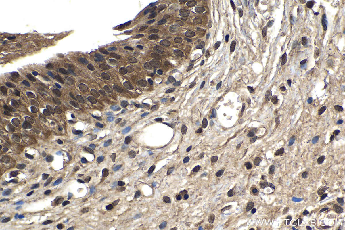 Immunohistochemistry (IHC) staining of human urothelial carcinoma tissue using PSMD10/Gankyrin Polyclonal antibody (12342-2-AP)
