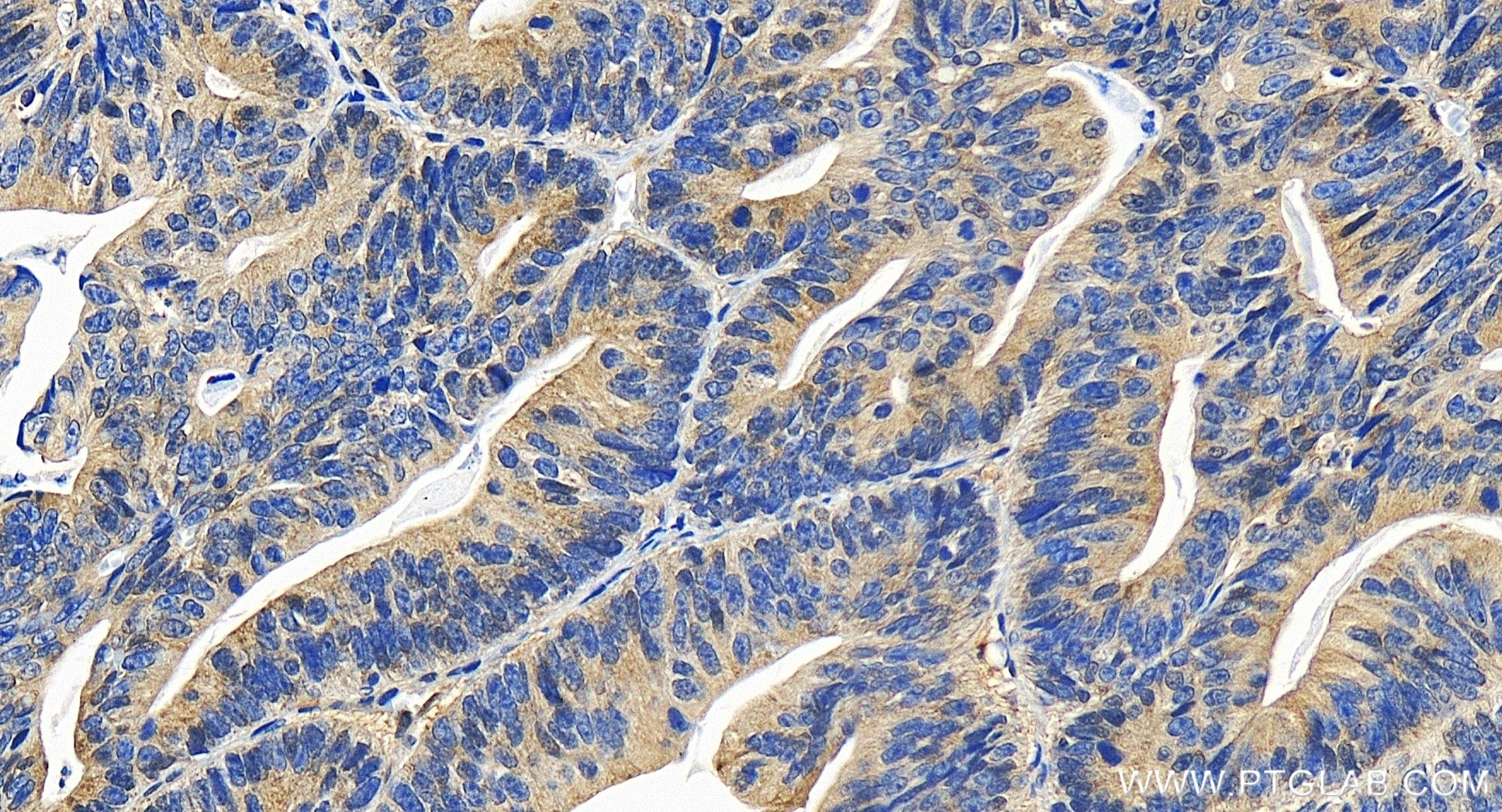 Immunohistochemistry (IHC) staining of human colon cancer tissue using PSMD10/Gankyrin Recombinant antibody (86120-2-RR)